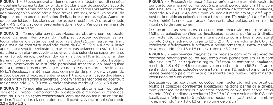 FIGURA 1 - Ultrassonografia demonstrando próstata de dimensões globalmente aumentadas, exibindo múltiplas áreas de as   
