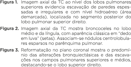 Figura 1  Imagem axial da TC ao nível dos lobos pulmonares superiores evidencia escavação de paredes espessadas e irr   