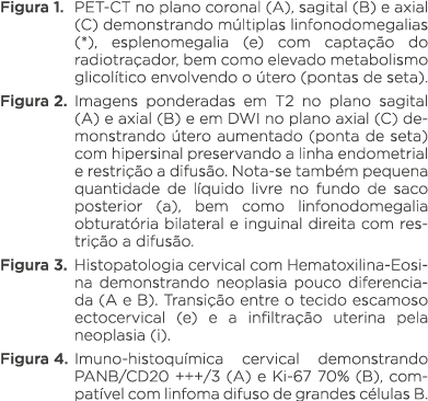 Figura 1  PET-CT no plano coronal (A), sagital (B) e axial (C) demonstrando múltiplas linfonodomegalias (*), esplenom   