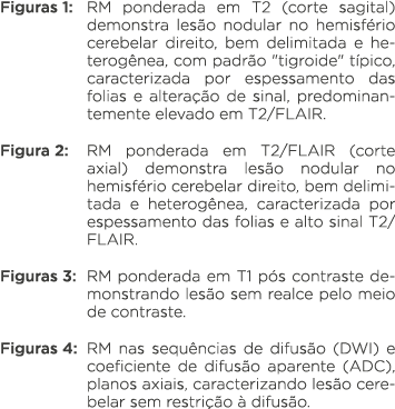 Figuras 1: RM ponderada em T2 (corte sagital) demonstra lesão nodular no hemisfério cerebelar direito, bem delimitada   