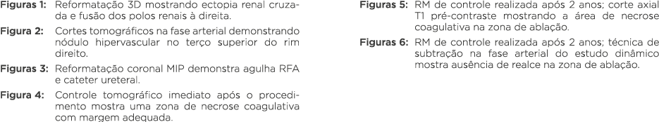 Figuras 1: Reformatação 3D mostrando ectopia renal cruzada e fusão dos polos renais à direita  Figura 2: Cortes tomog   