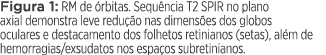 Figura 1: RM de órbitas  Sequência T2 SPIR no plano axial demonstra leve redução nas dimensões dos globos oculares e    