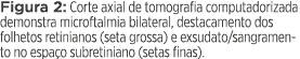 Figura 2: Corte axial de tomografia computadorizada demonstra microftalmia bilateral, destacamento dos folhetos retin   