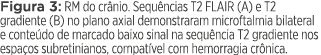 Figura 3: RM do crânio  Sequências T2 FLAIR (A) e T2 gradiente (B) no plano axial demonstraram microftalmia bilateral   
