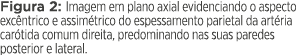 Figura 2: Imagem em plano axial evidenciando o aspecto excêntrico e assimétrico do espessamento parietal da artéria c   