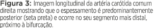 Figura 3: Imagem longitudinal da artéria carótida comum direita mostrando que o espessamento é predominantemente post   