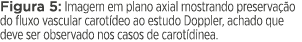 Figura 5: Imagem em plano axial mostrando preservação do fluxo vascular carotídeo ao estudo Doppler, achado que deve    