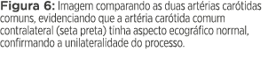 Figura 6: Imagem comparando as duas artérias carótidas comuns, evidenciando que a artéria carótida comum contralatera   