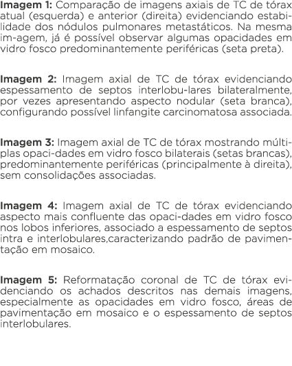 Imagem 1: Comparação de imagens axiais de TC de tórax atual (esquerda) e anterior (direita) evidenciando estabilidade   