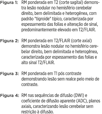 Figura 1: RM ponderada em T2 (corte sagital) demonstra lesão nodular no hemisfério cerebelar direito, bem delimitada    