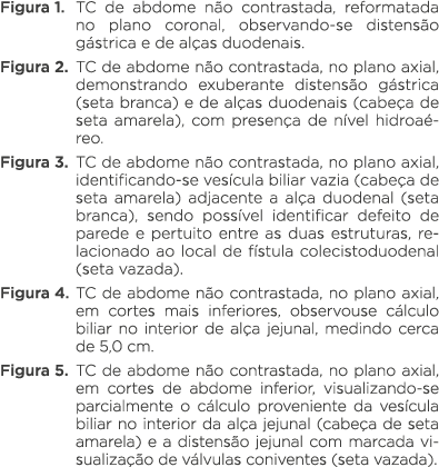 Figura 1  TC de abdome não contrastada, reformatada no plano coronal, observando-se distensão gástrica e de alças duo   