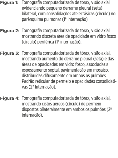 Figura 1: Tomografia computadorizada de tórax, visão axial evidenciando pequeno derrame pleural (seta) bilateral, com   