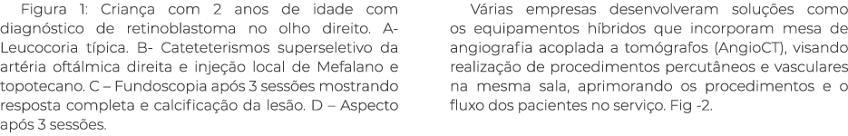 Figura 1: Crian a com 2 anos de idade com diagn stico de retinoblastoma no olho direito. A- Leucocoria t pica. B- Cat...